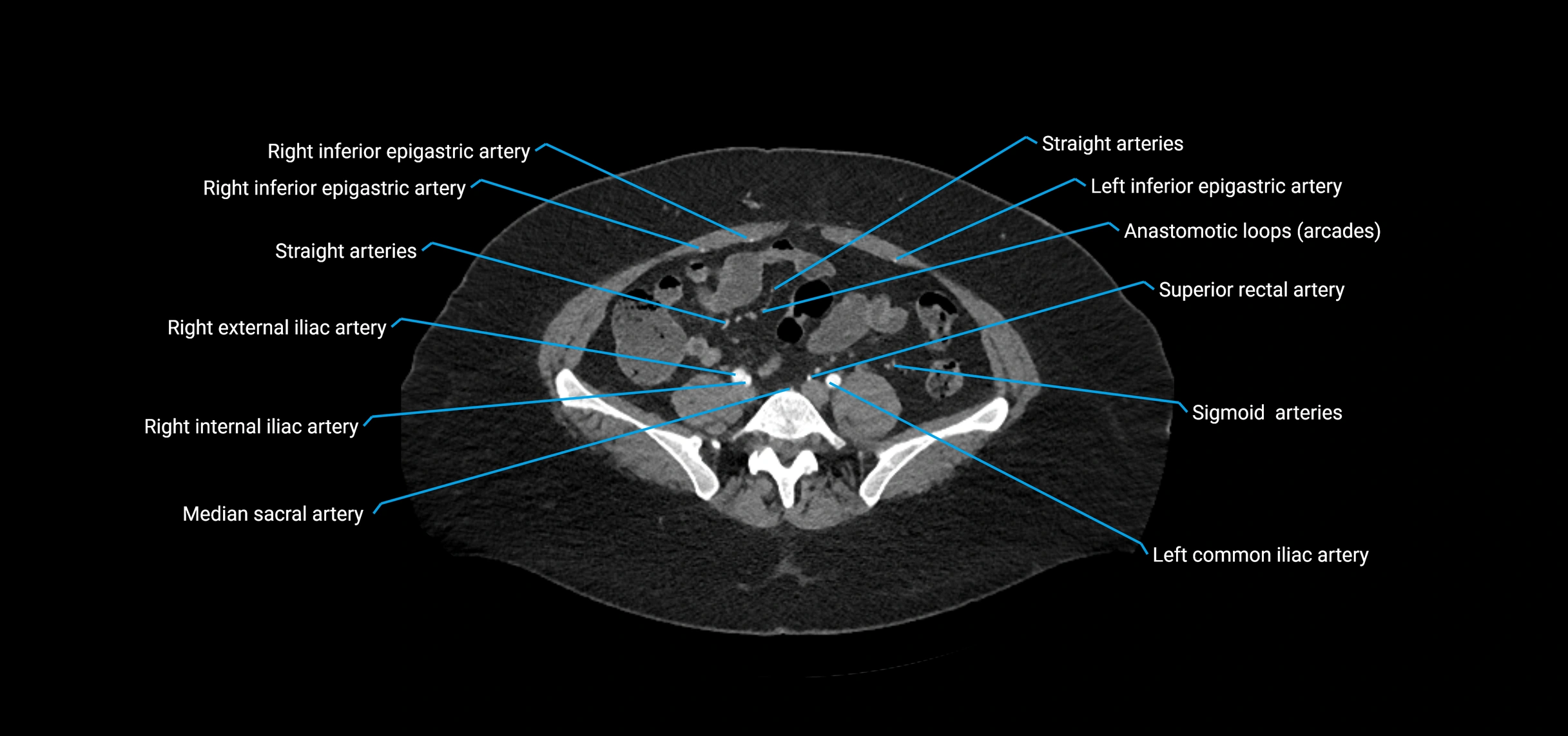 CTA abdomen axial cross sectional anatomy labelled image_167 (2).webp